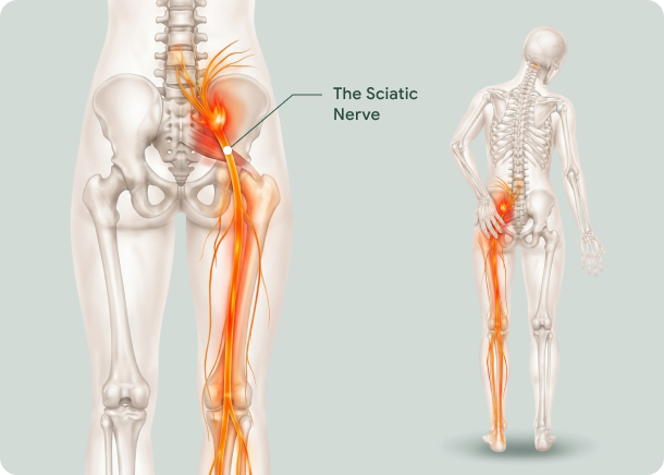 Sciatica