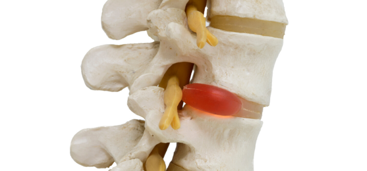 Slipped Discs and How Bowen Therapy Can Help